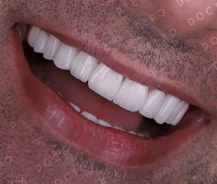 Dental Implants in Turkey