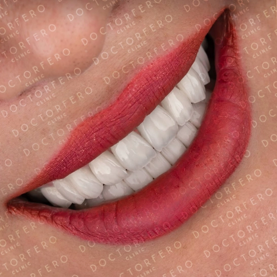 Veneers in Turkey Before After