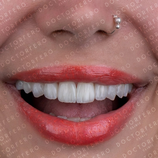 Veneers in Turkey Before After