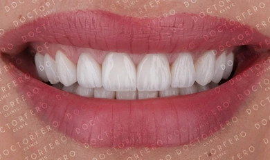 Veneers in Turkey
