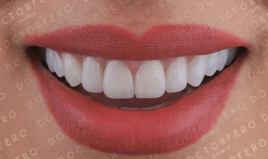 Veneers in Turkey