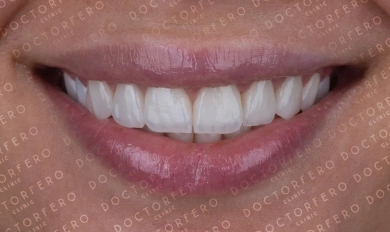 Veneers in Turkey