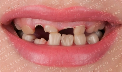 Veneers in Turkey