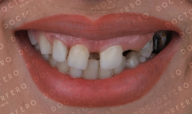 Veneers in Turkey