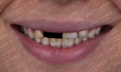 Veneers in Turkey