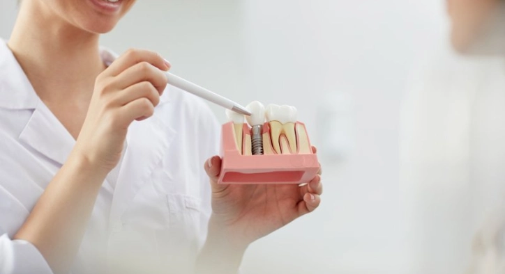 How Long Do Dental Implants Last?