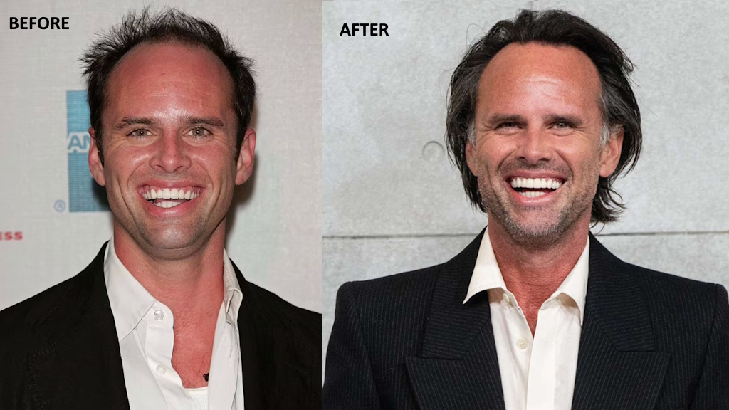 Side-by-side comparison of Walton Goggins showing older and newer photos, highlighting subtle changes in his teeth, including improved color and cleanliness.