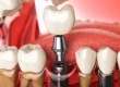 What Is 3 On 6 Dental Implants In Turkey?