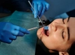 Why Is Turkey So Cheap For Veneers?