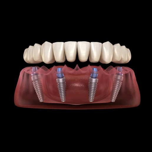 All-on-4 Dental Implants in Turkey