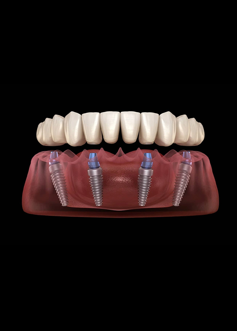 All-on-4 Dental Implants in Turkey
