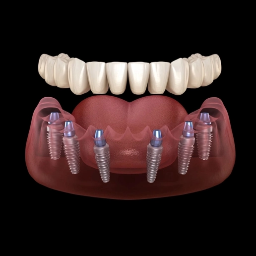 All-on-6 Dental Implants in Turkey