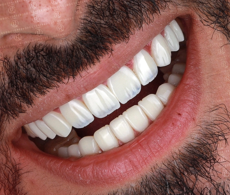 Dental Crowns in Turkey
