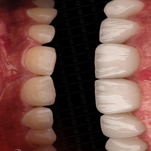 E-Max Crowns in Turkey