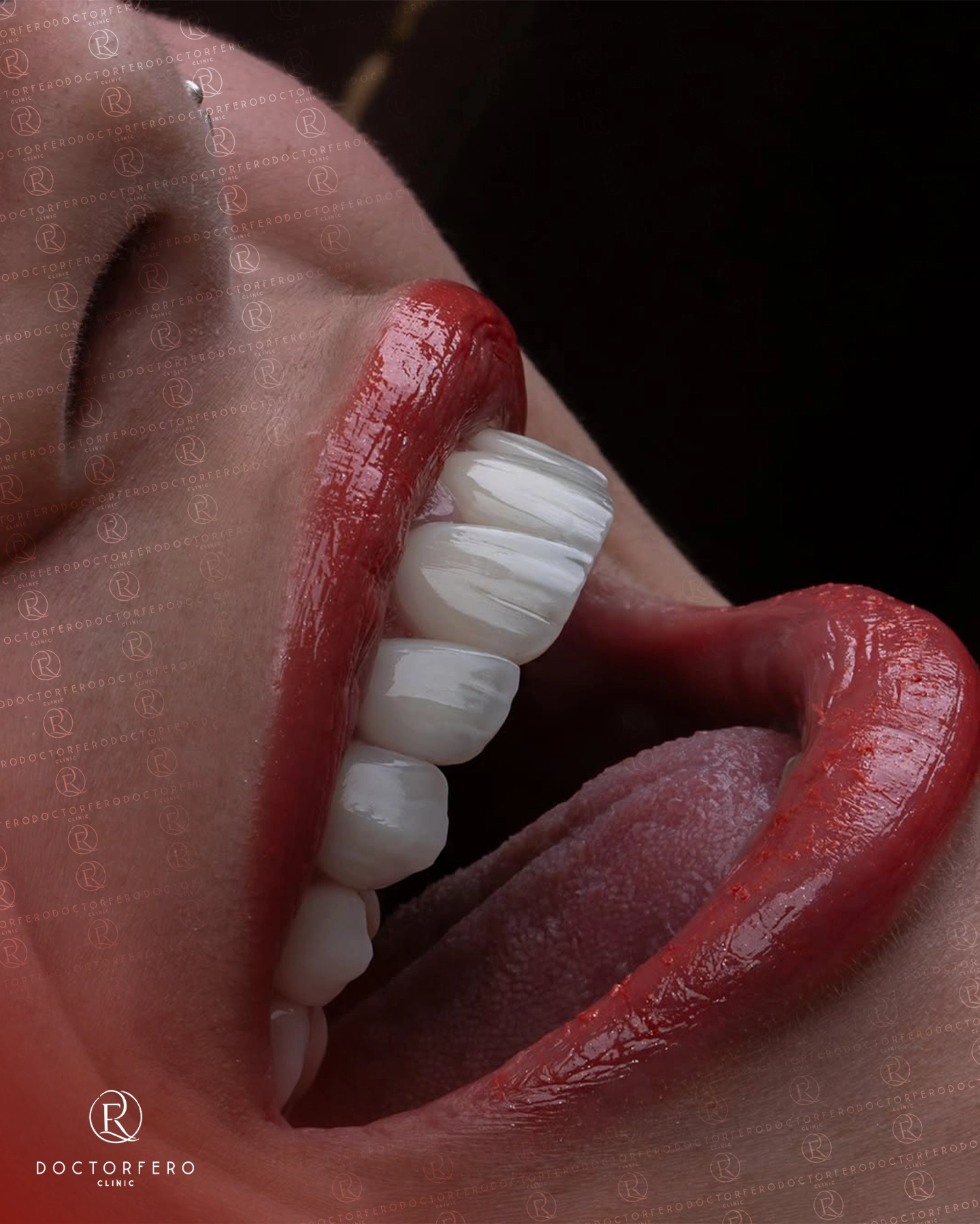 Veneers in Turkey