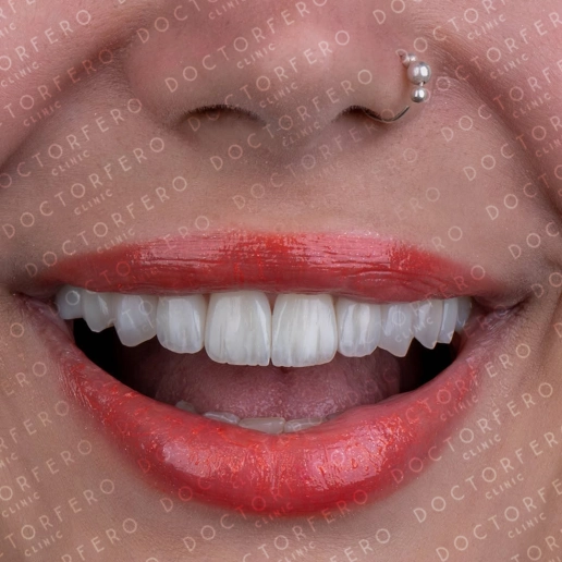 Zirconia Crowns in Turkey