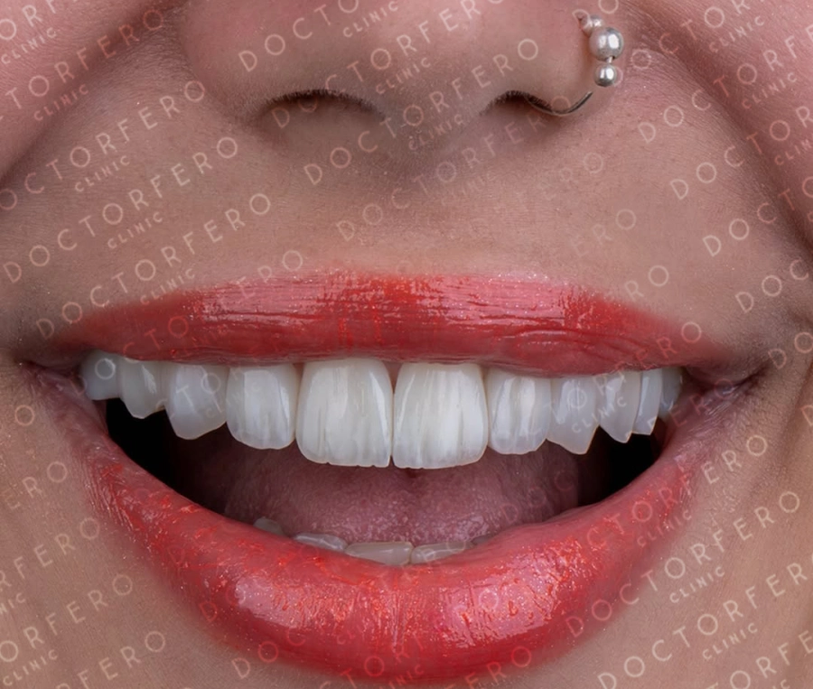 Zirconia Crowns in Turkey